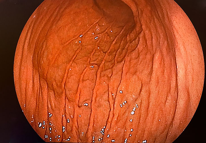 正常な胃粘膜画像